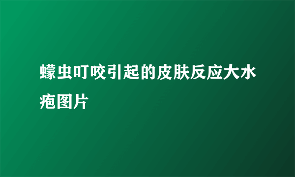 蠓虫叮咬引起的皮肤反应大水疱图片