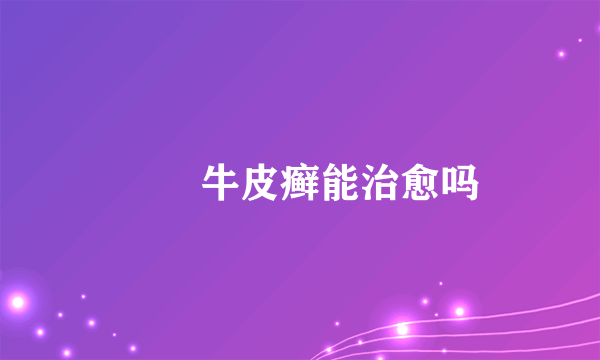 　　牛皮癣能治愈吗