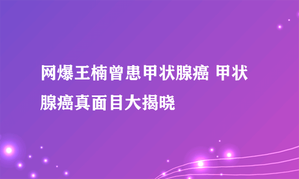 网爆王楠曾患甲状腺癌 甲状腺癌真面目大揭晓